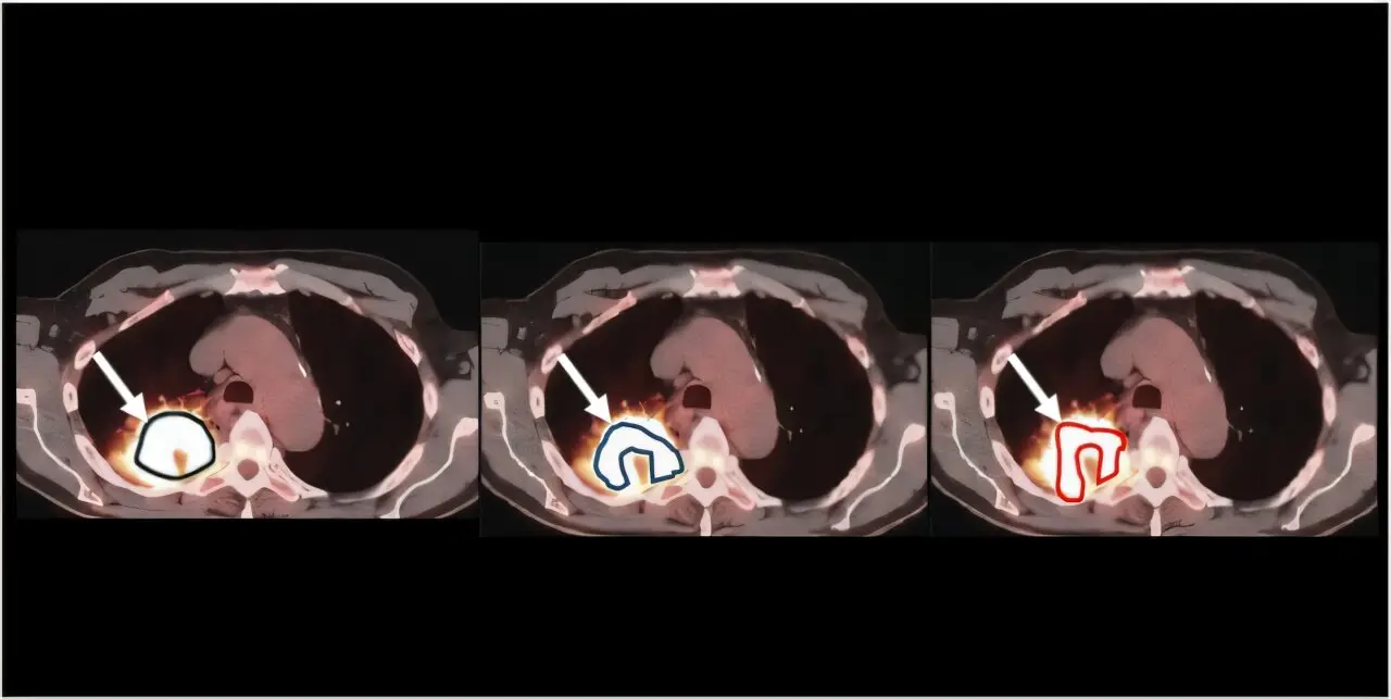 No gold standard needed: Method ranks the precision of medical imaging measurements