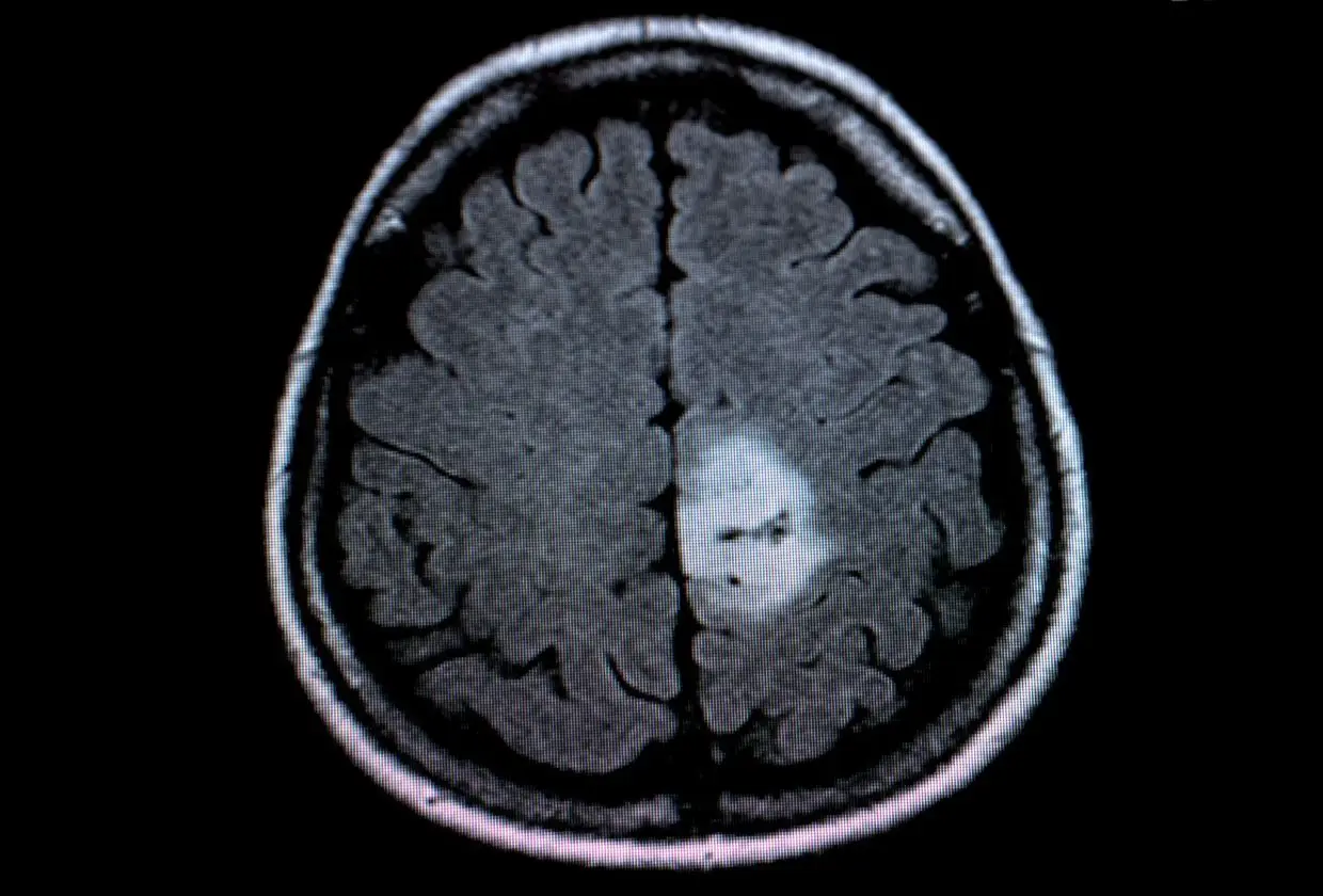 AI could help spare brain tumour patients MRI dye injections